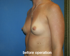 plastic-surgery-breast-augmentation